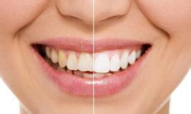 速效清洁美牙仪神器洗牙器去除氟斑牙美白仪牙齿冷光仪